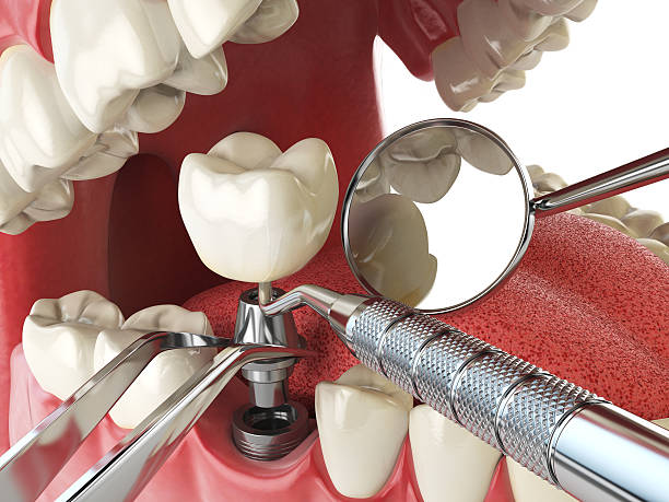 Best Urgent Care for Lost Fillings or Crowns in Cattaraugus, NY